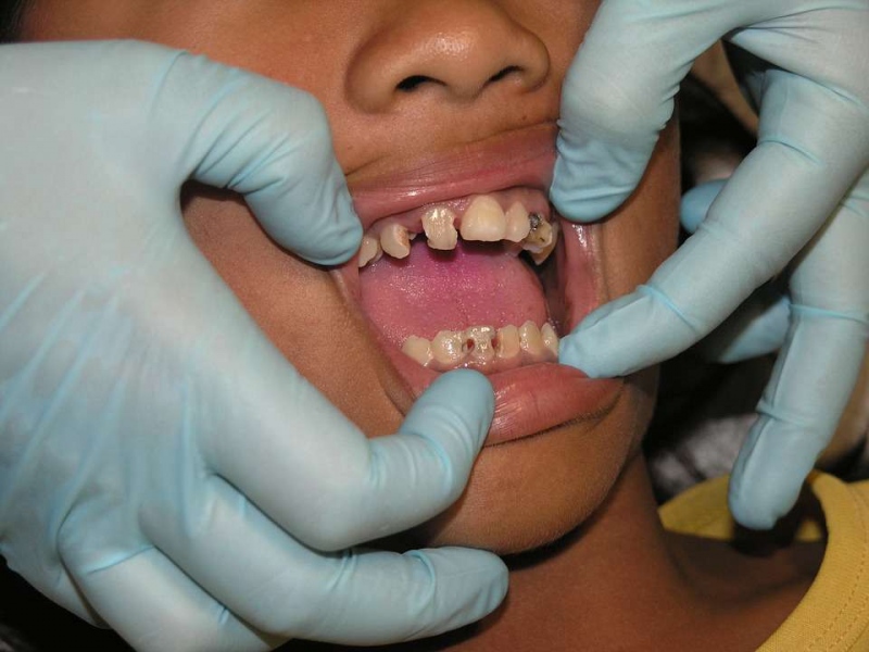 补牙戴牙套的副作用是什么补牙戴牙套要注意哪些问题